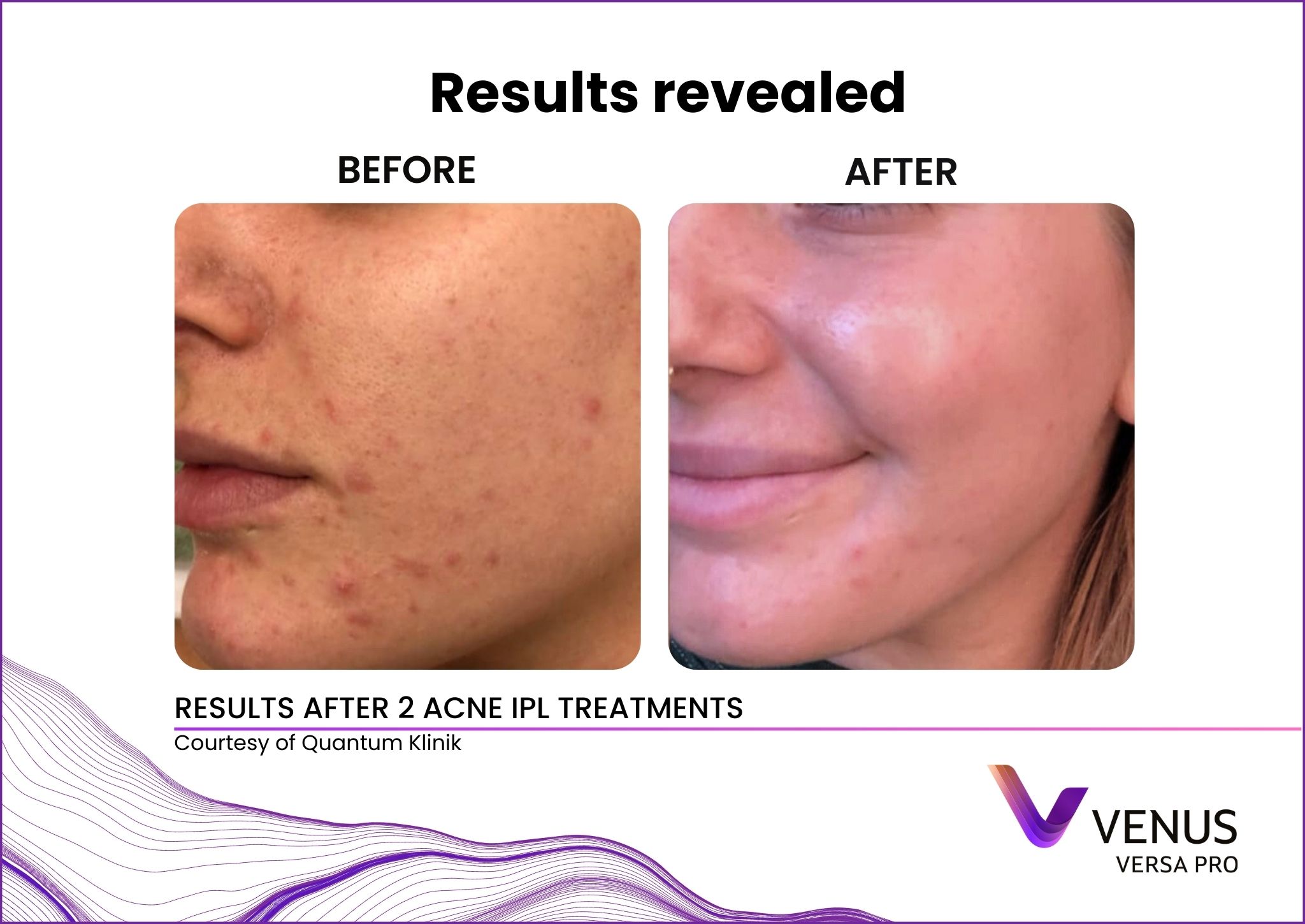Acne IPL before and after results