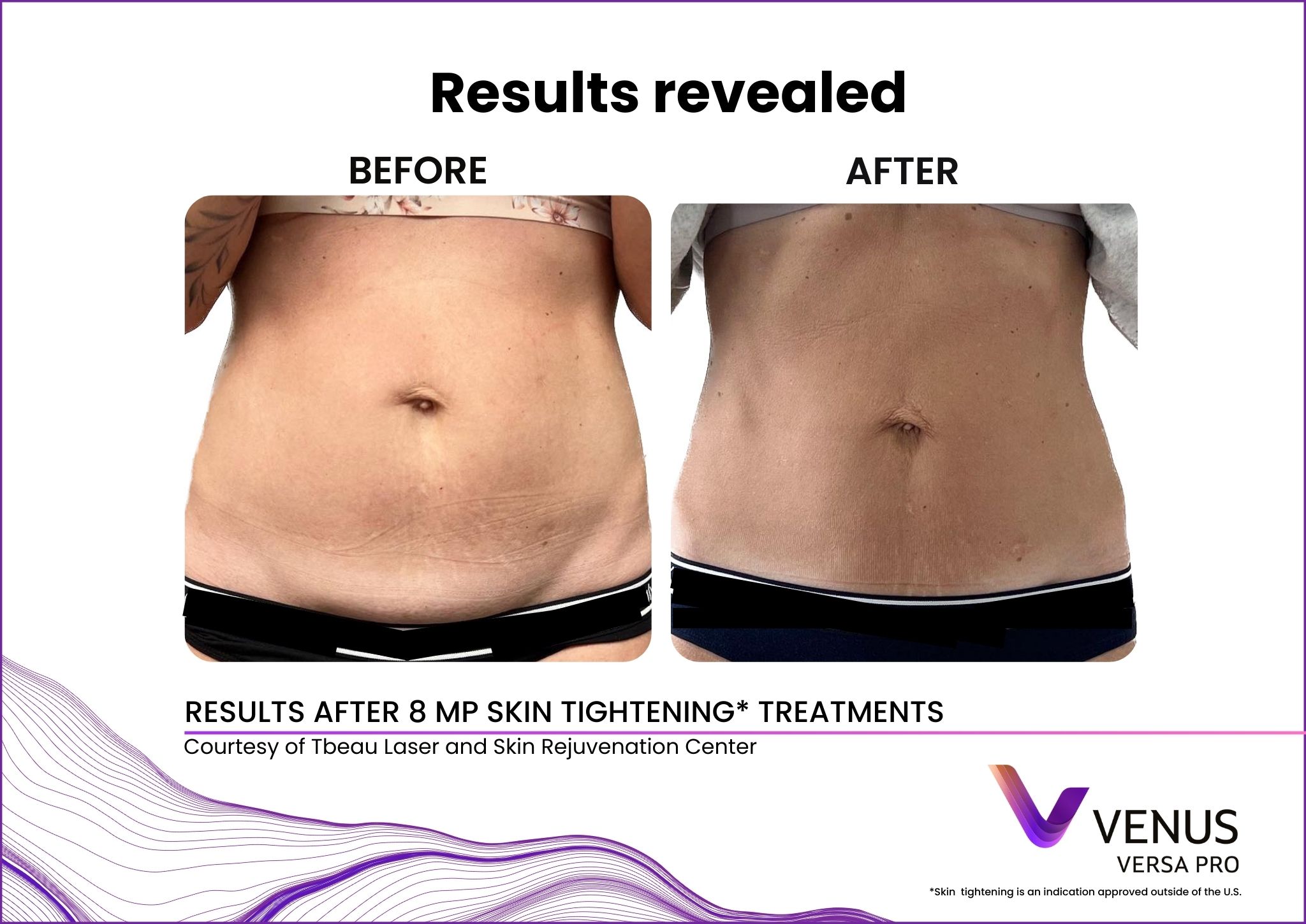 Body skin tightening before and after results