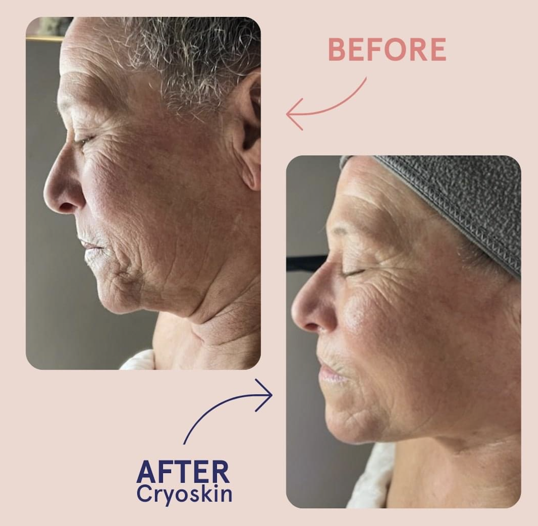 CryoFacial before and after result 2