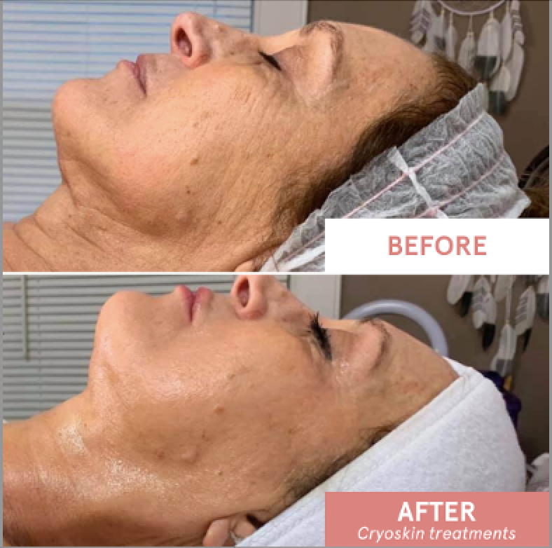 CryoFacial before and after result 1