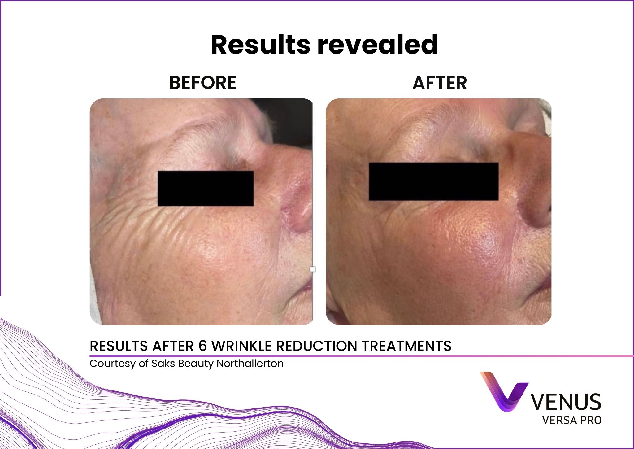 Diamond Polar wrinkle reduction before and after results