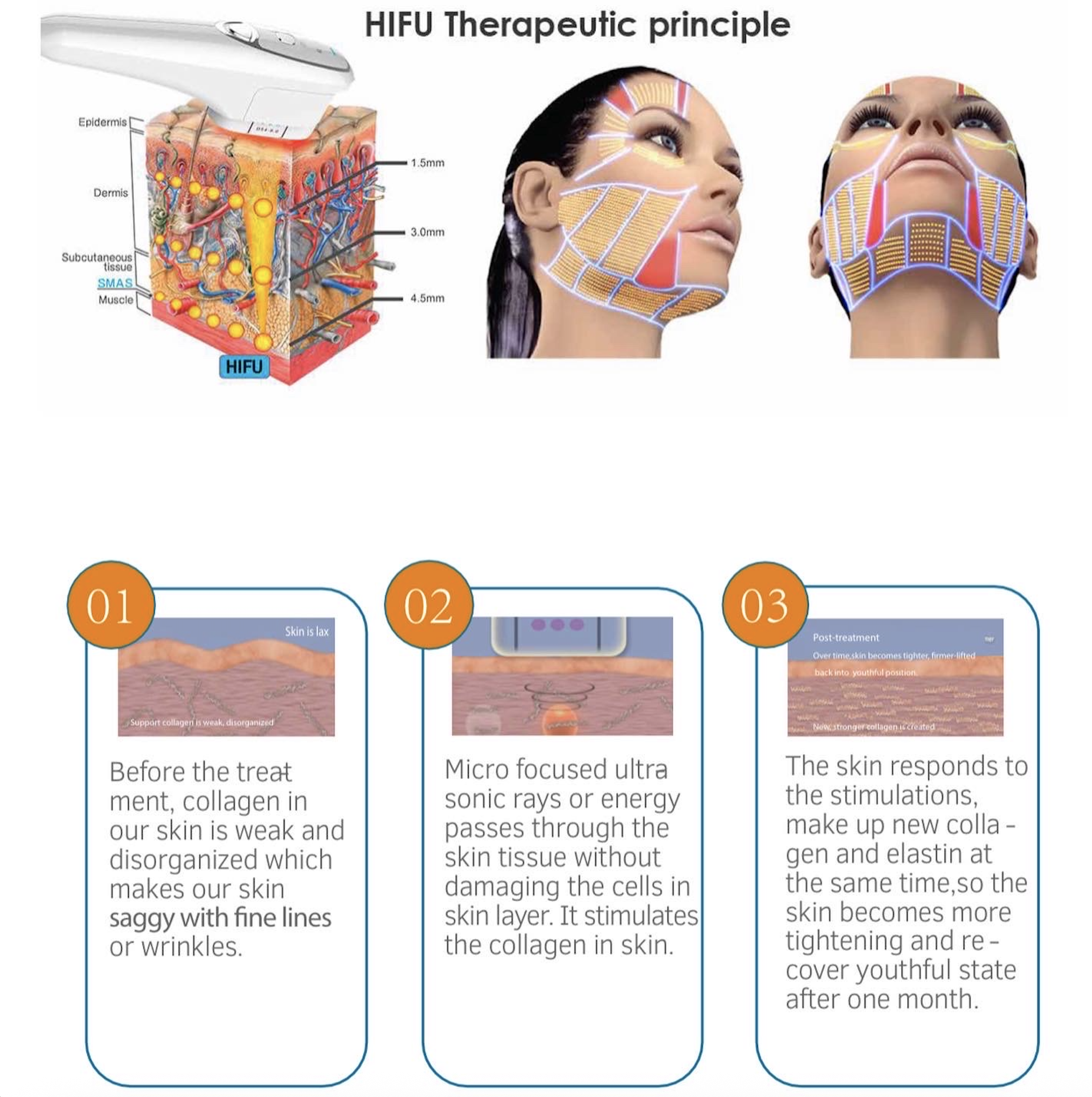 HIFU therapeutic principle diagram