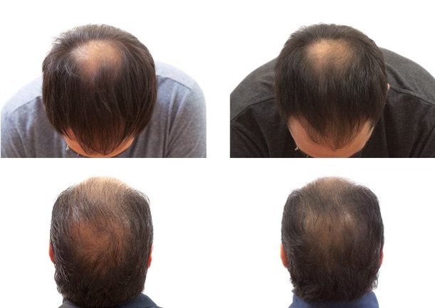 PRGF hair restoration before and after — Valley Aesthetic