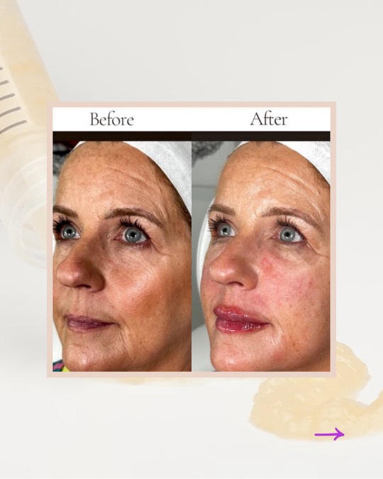 PRGF facial before and after — Valley Aesthetic