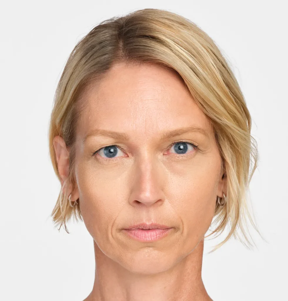 Jackie after RADIESSE treatment — 4 weeks
