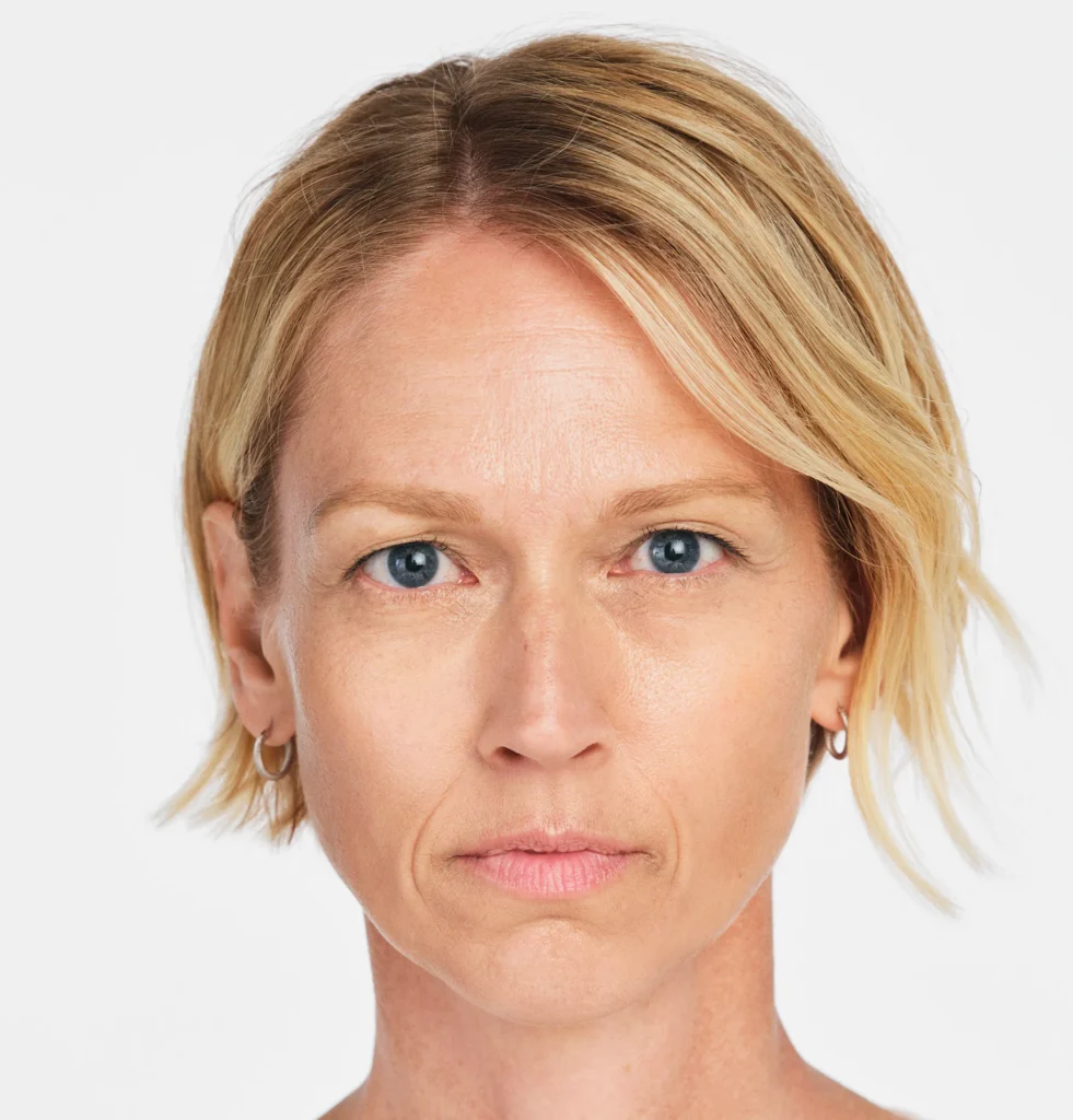 Jackie before RADIESSE treatment