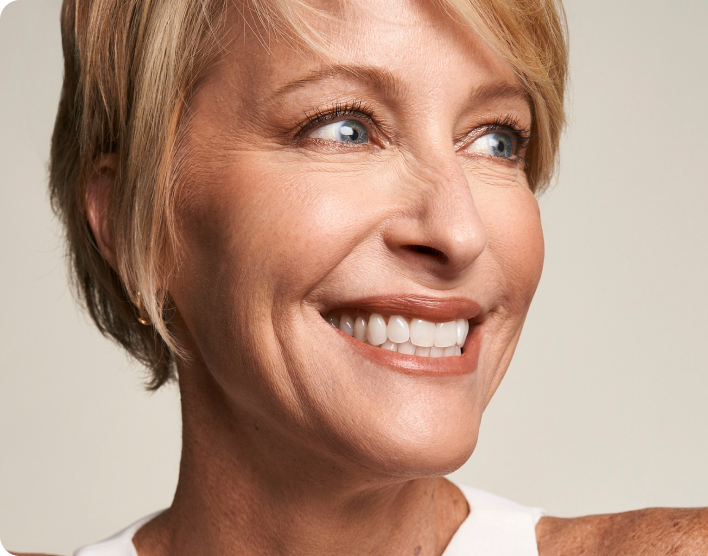 RADIESSE patient results — natural rejuvenation