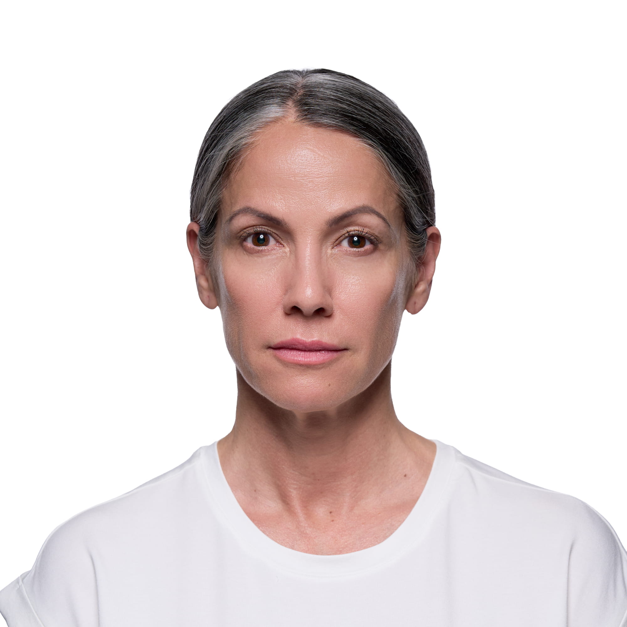 Jennifer after Revanesse treatment