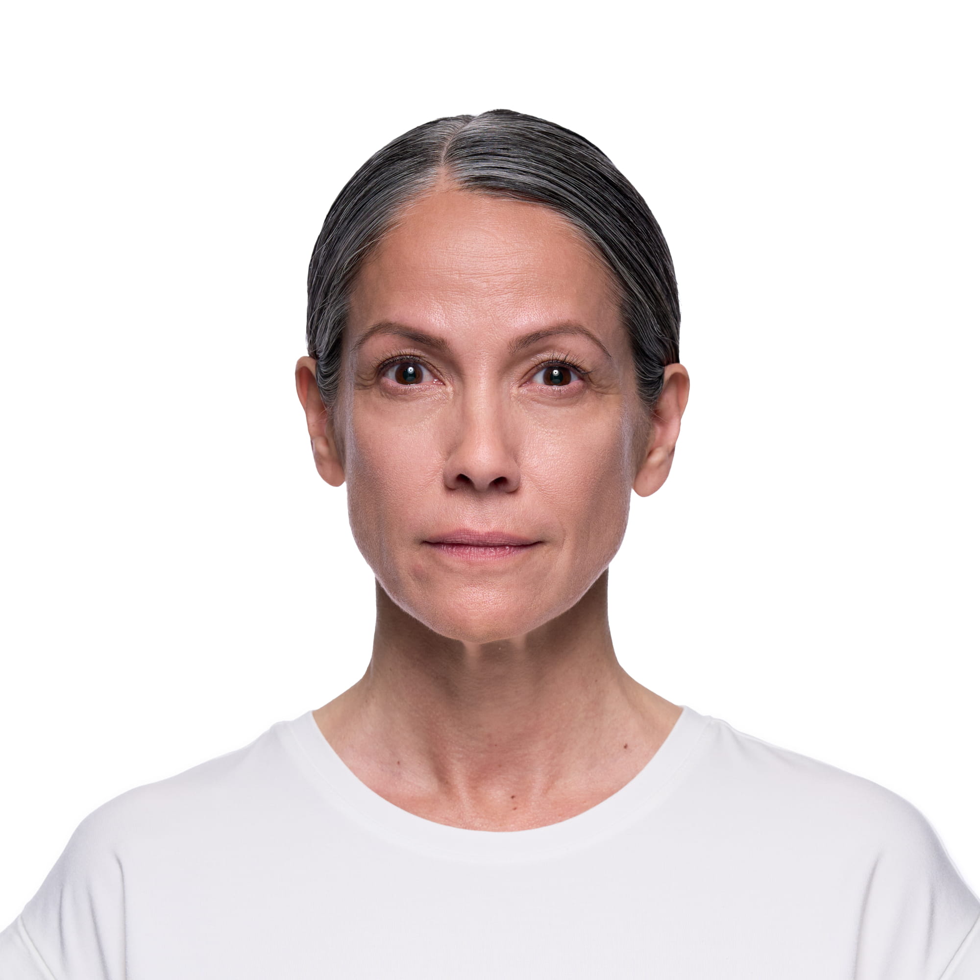 Jennifer before Revanesse treatment
