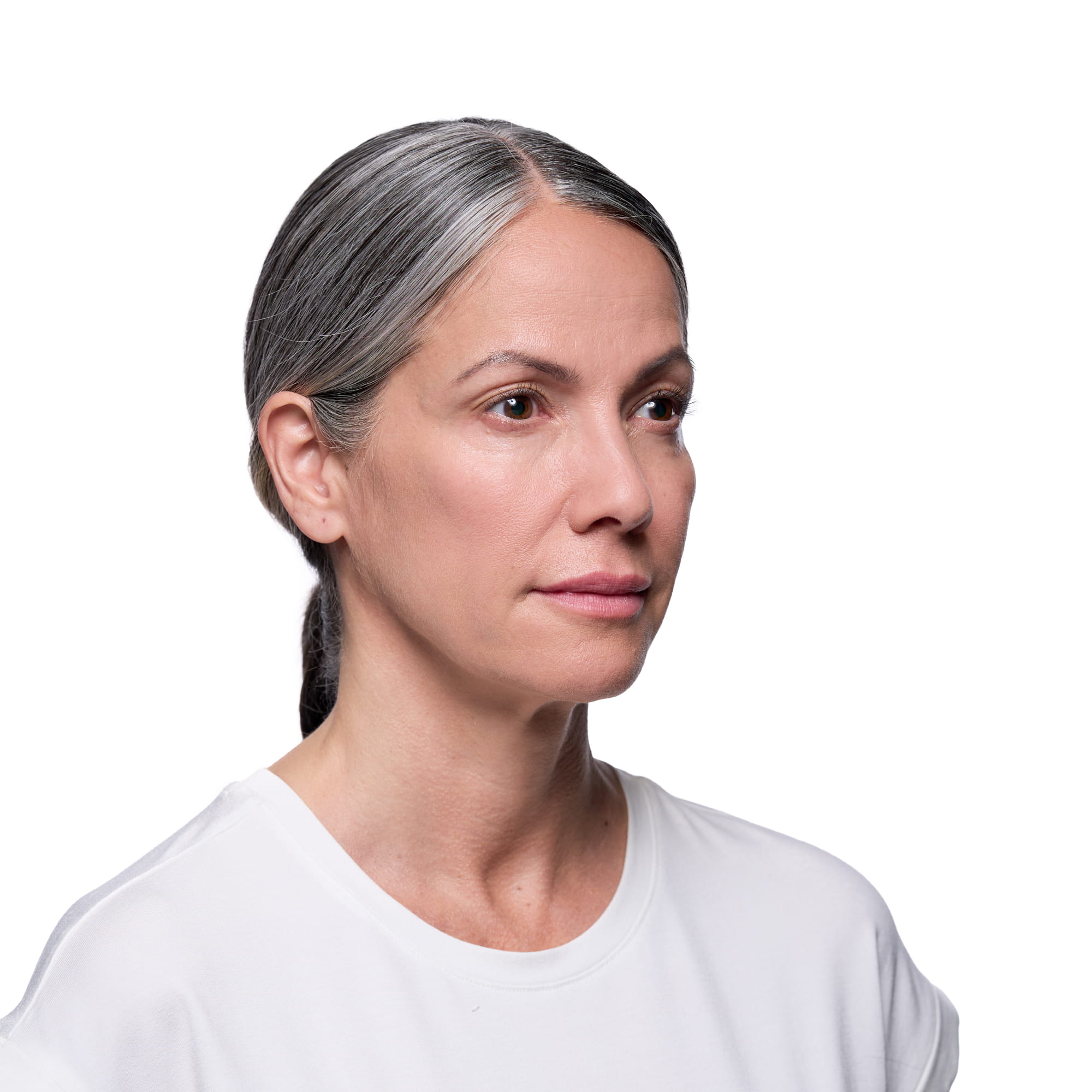 Revanesse dermal filler results — Valley Aesthetic
