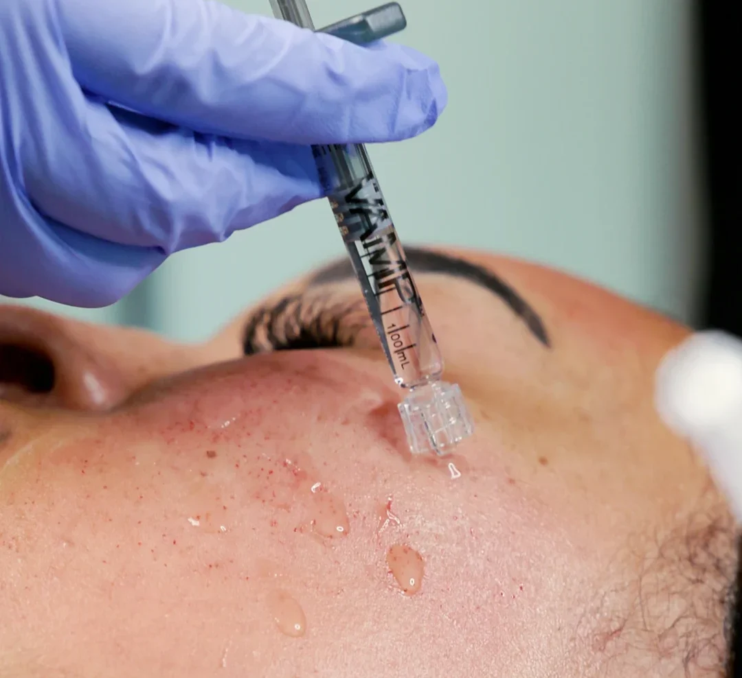 VAMP Advanced microneedling treatment at Valley Aesthetic