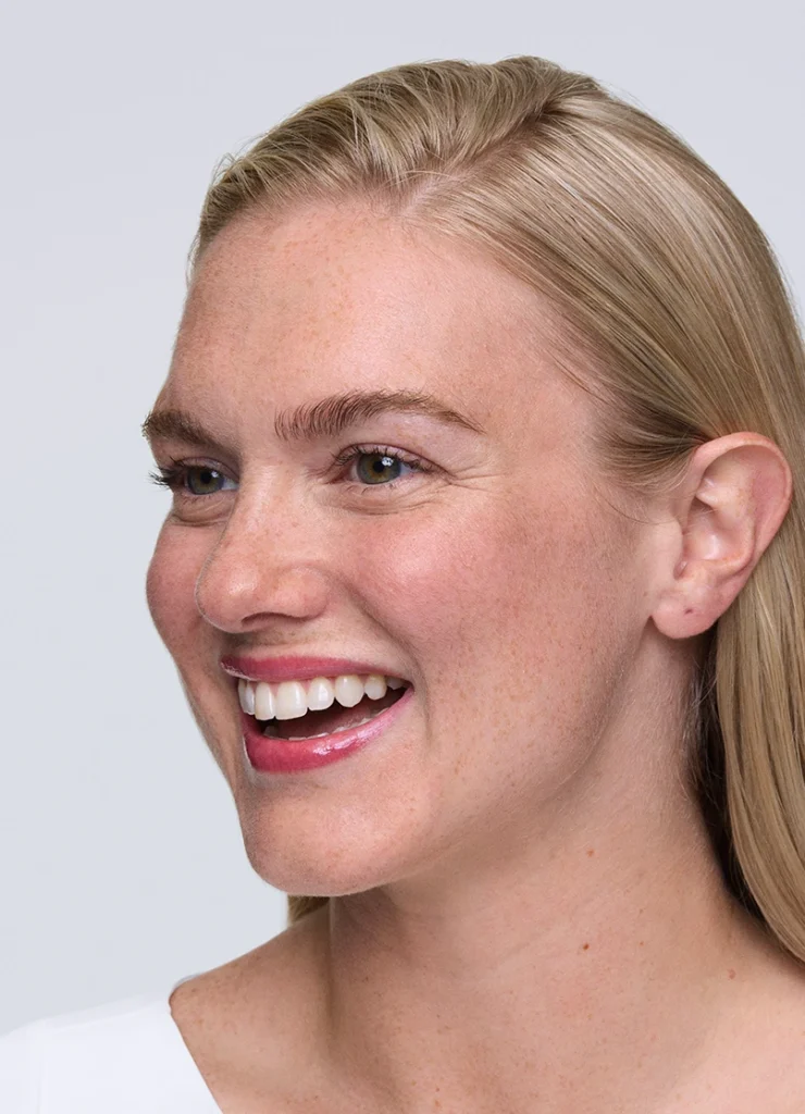 Before XEOMIN crow's feet treatment