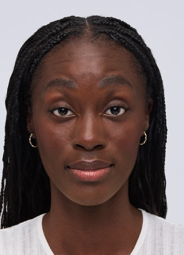 Before XEOMIN forehead lines treatment