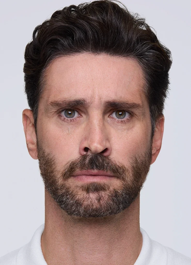 Before XEOMIN frown lines treatment