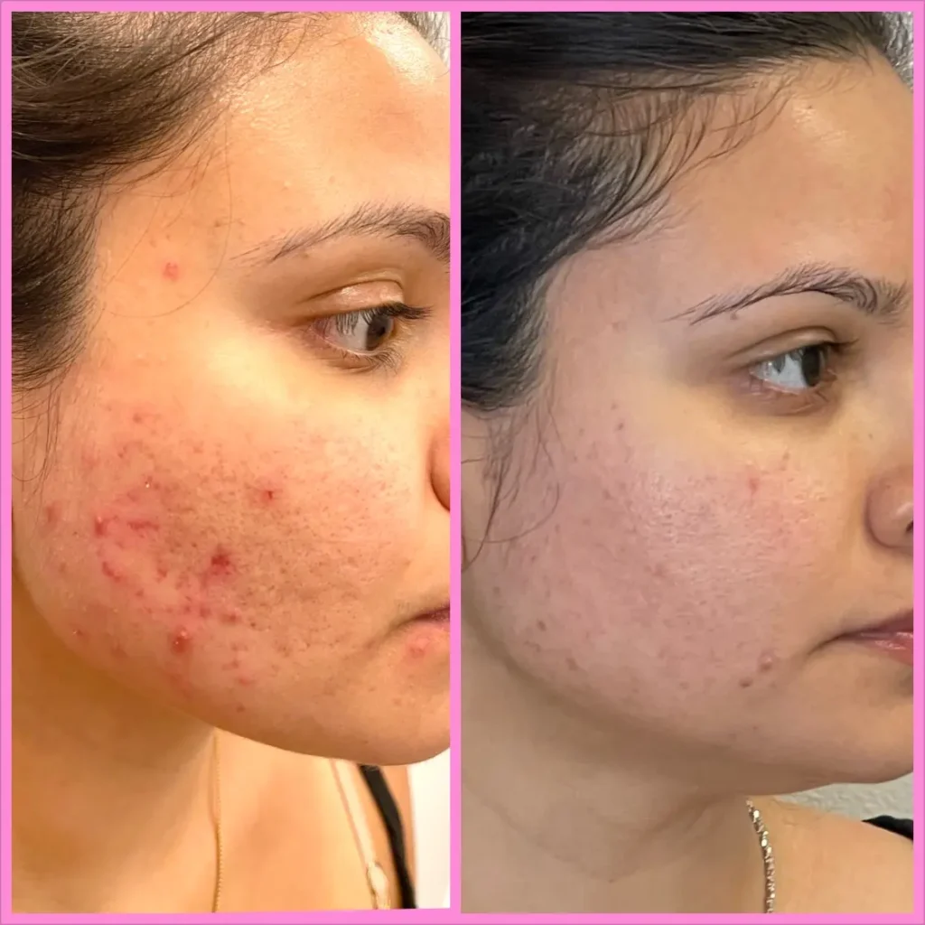 Before and After - Valley Aesthetic, Skin Care Clinic, North